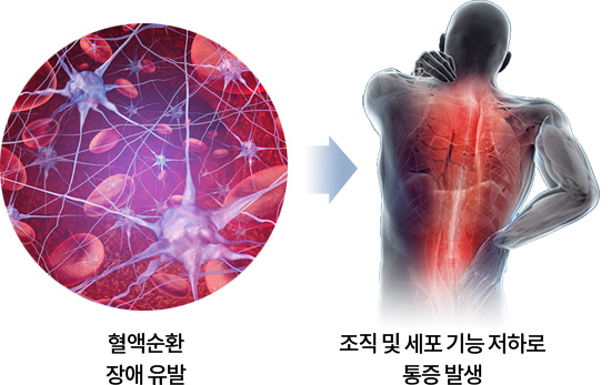 혈액순환 장애 유발 , 조직 및 세포 기능 저하로 통증 발생
