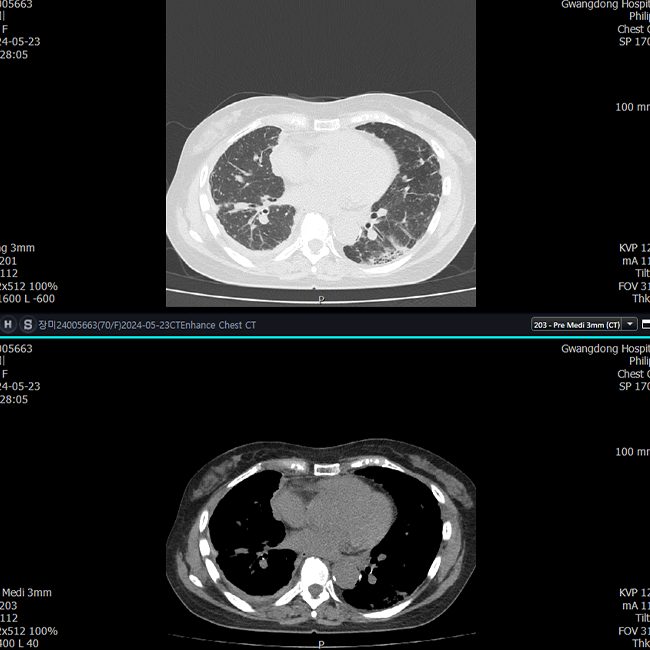 전신 암・종양 스크리닝
