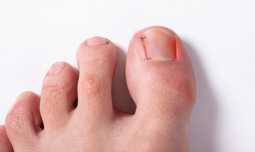 발톱 외측성형술 / 근치술