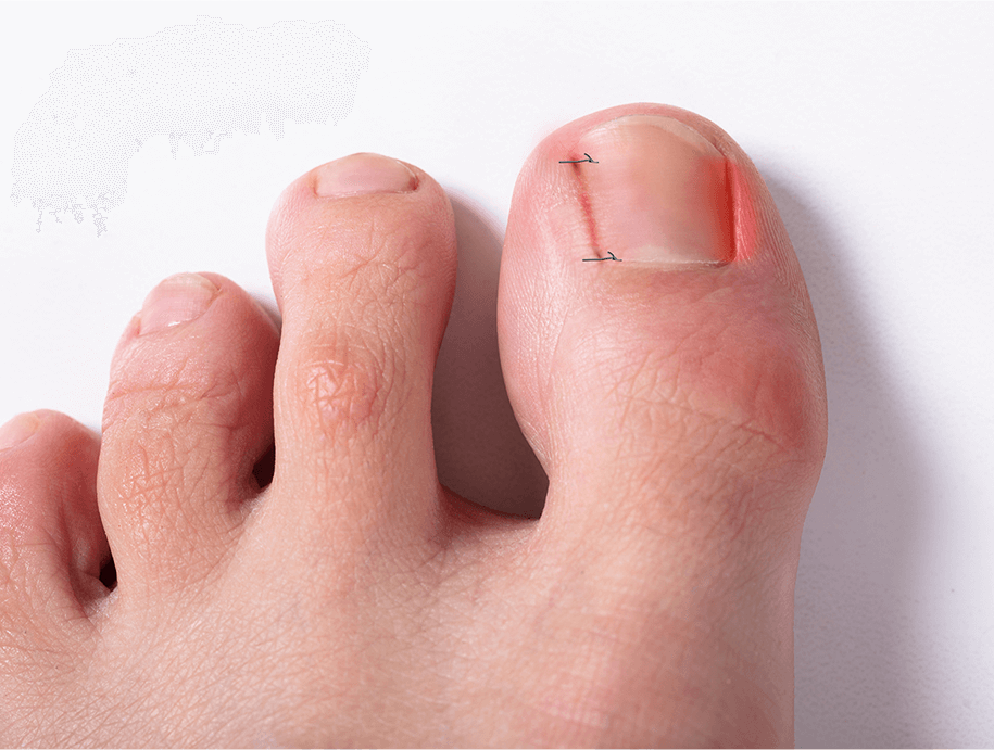 발톱 외측성형술 / 근치술