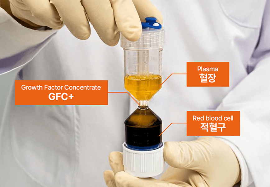 고농축 PRP 재생 주사