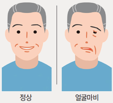 안면마비 vs 정상 얼굴: 증상 비교