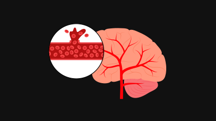 출혈성 뇌졸중(뇌출혈)